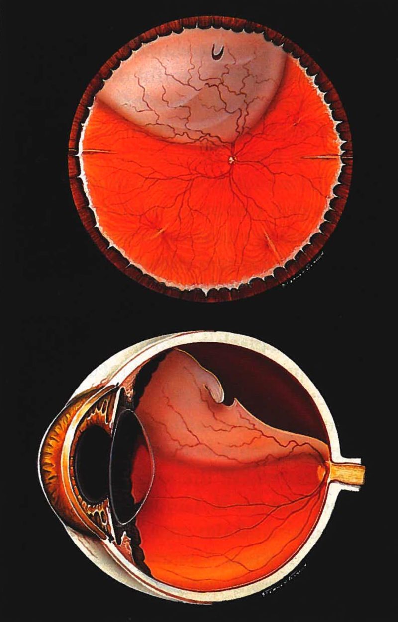 What Is A Retinal Detachment Venice Retina