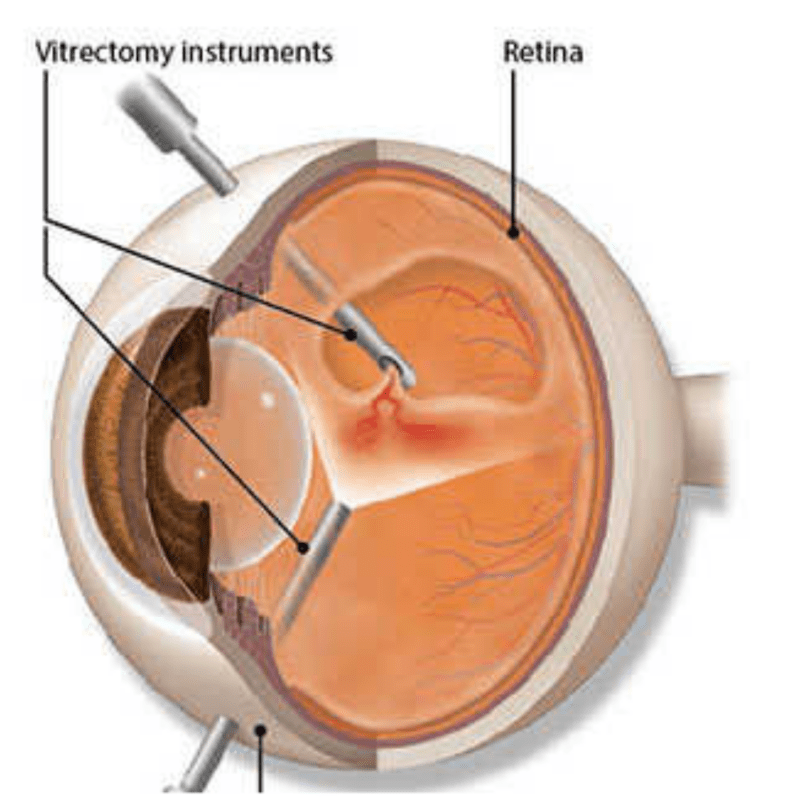 What Is Vitrectomy Retinal Detachment Repair