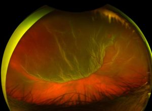 RD1 Retinal Detachment Visual Representation | Clinical Treatment for Retinal Detachment