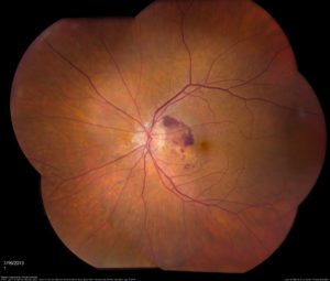 Wet AMD2 Macular Degeneration | Wet AMD