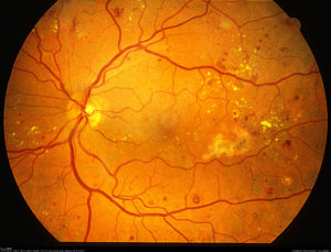 Proliferative Diabetic Retinopathy | Eyeball Visual