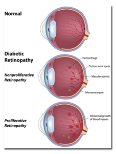 Vitrectomy for Diabetic Retinopathy | Eye Diagram