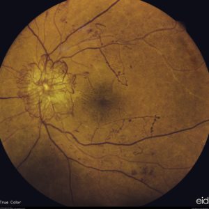 Retinal Detachment | Eye Visual Image