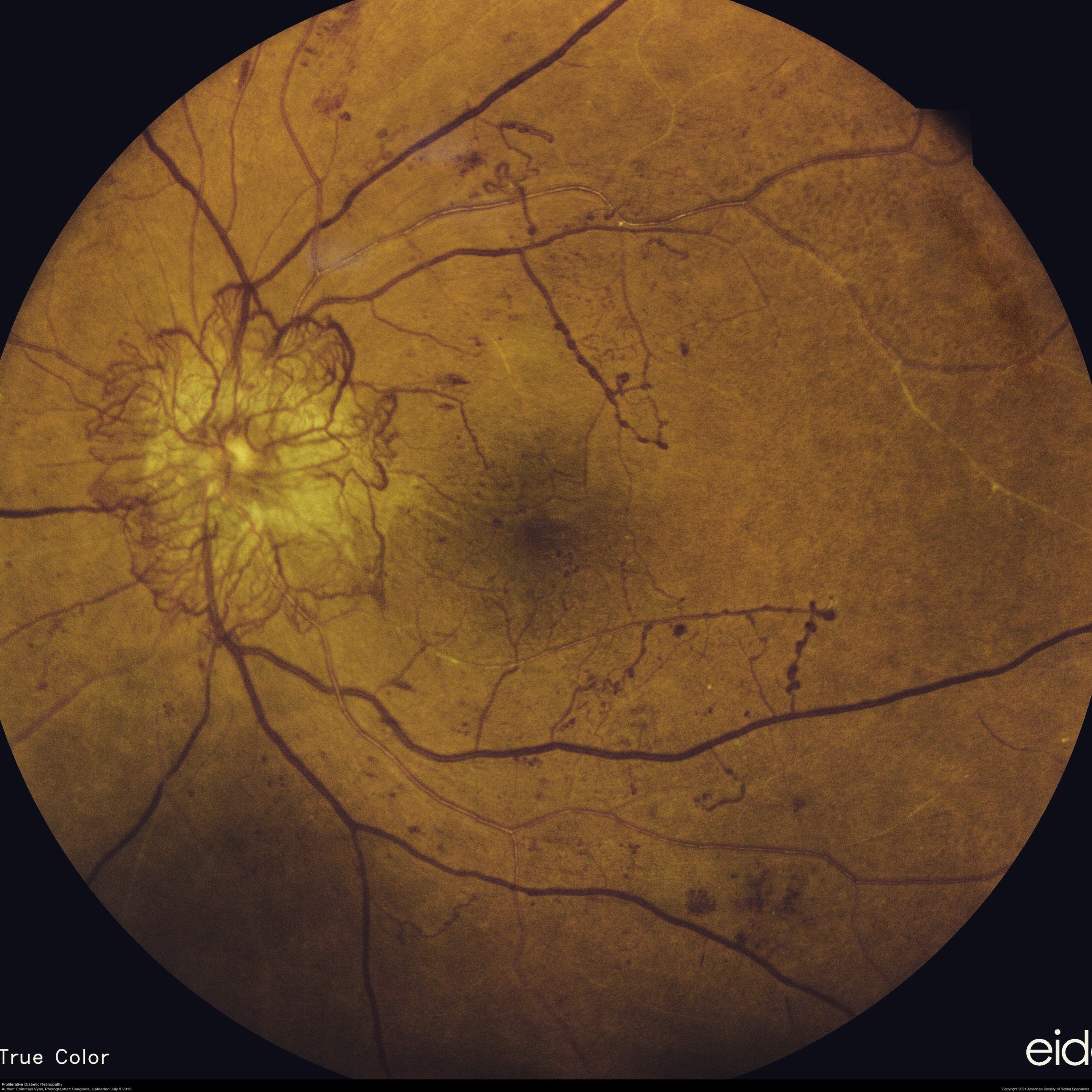 Retinal Detachment | Eye Visual Image