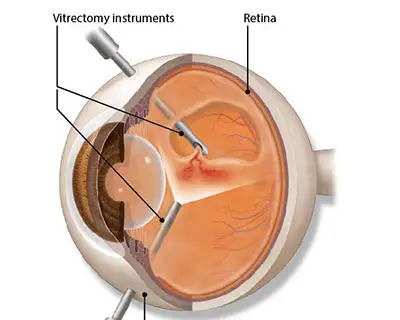 Vitrectomy Procedure | Eye Procedure Diagram