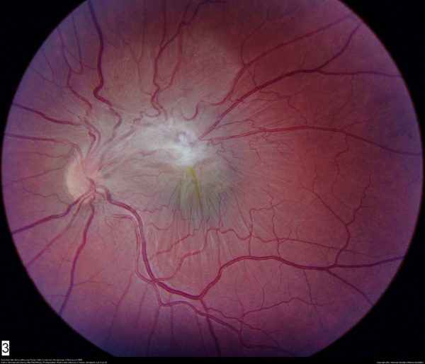 Epiretinal Membrane | Retina Eye Images