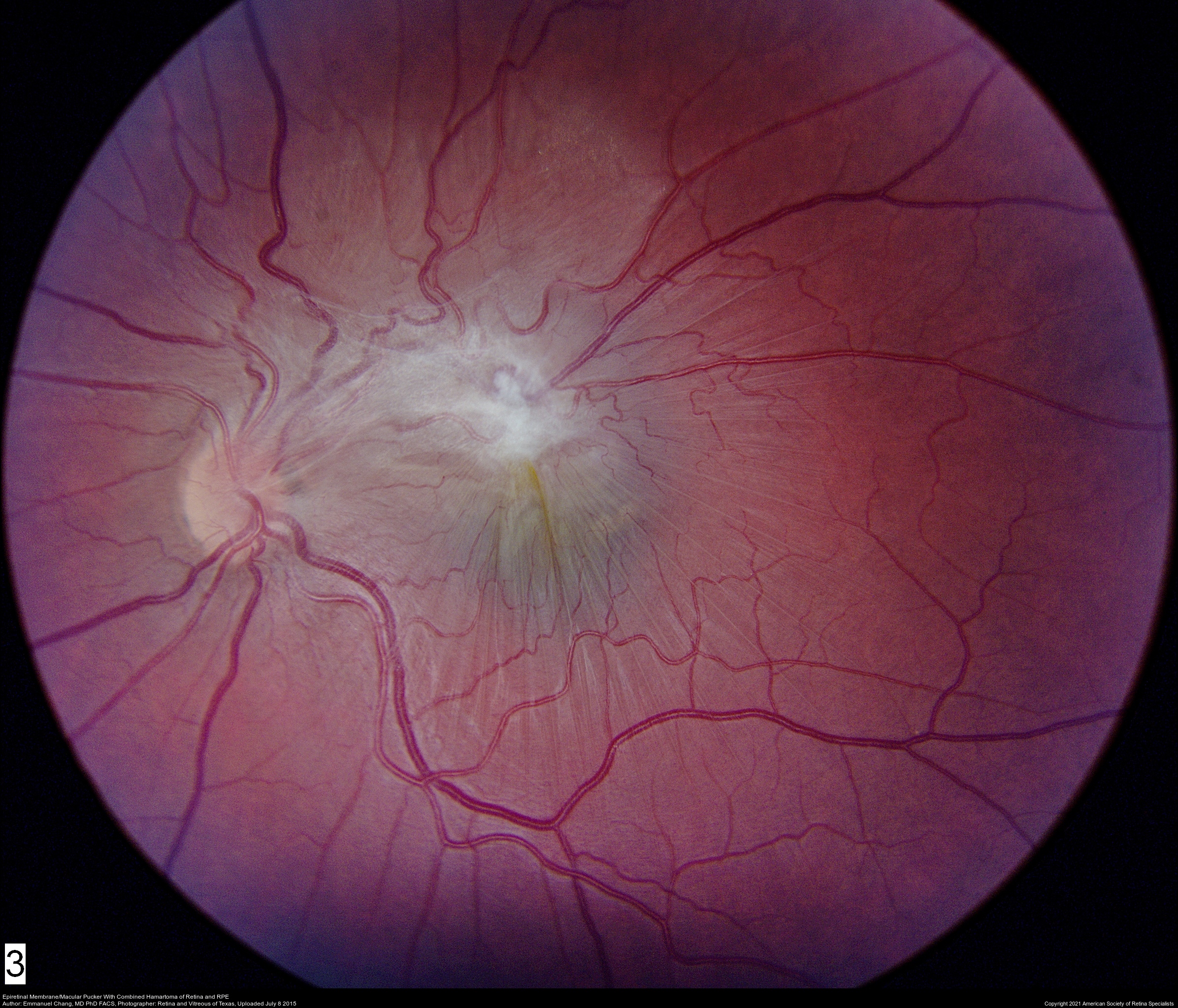 Epiretinal Membrane | Retina Eye Images