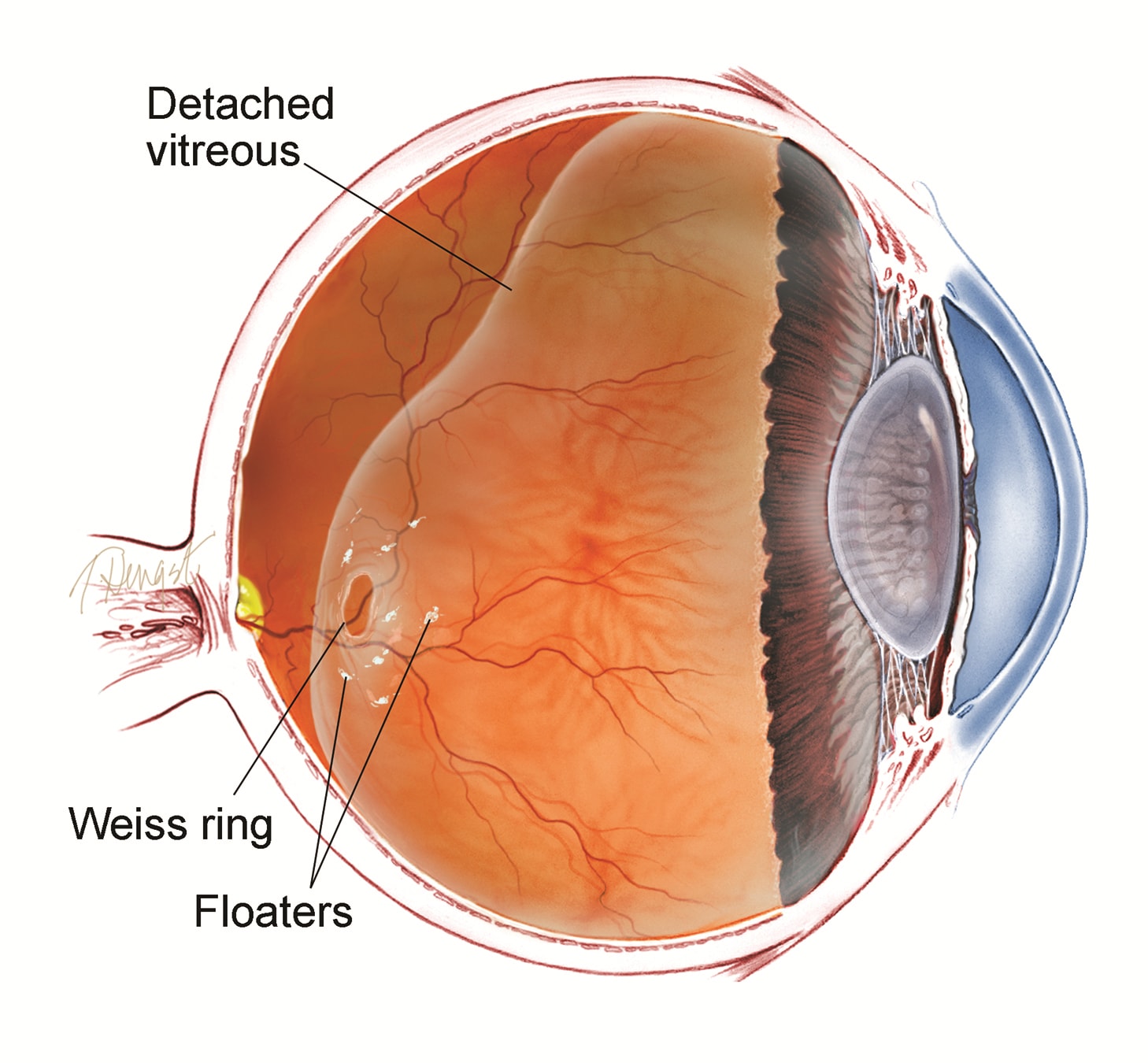 Eye Floaters and Eye Flashes Condition | Eye Diagram Showing Flashes and Floaters