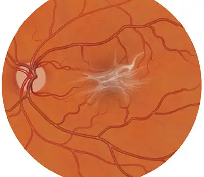 Macular Pucker | Retina Conditions Shown in an Image