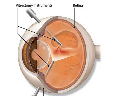 Vitrectomy Instruments | Retina Diagram