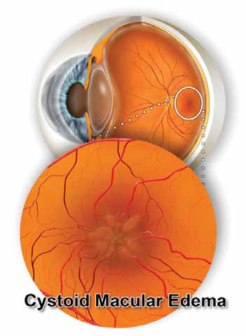 Cystoid Macular Edema | Retina Eye Image