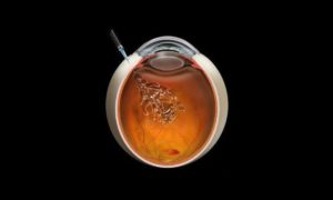Intravitreal Injection | Diagram of Eye