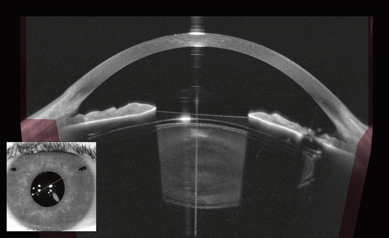 OCT Anterior Segment Image | Eye Xray