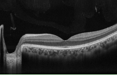 OCT Retina Image | Xray of Eye