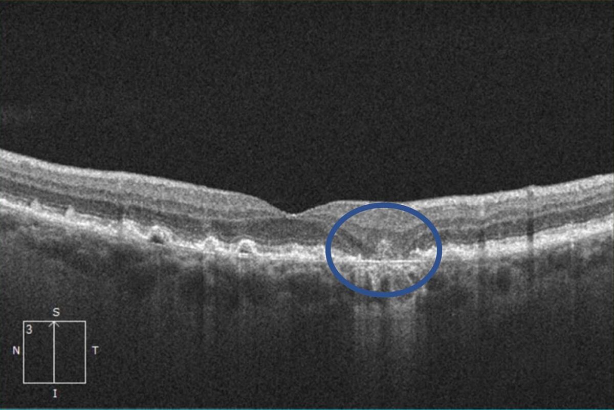 Syfovre Dry Macular Degeneration Treatment In Venice Fl 