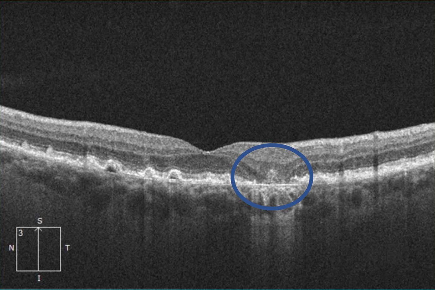 Retinal atrophy, a common symptom of advanced dry macular degeneration, causing blind spots in central vision