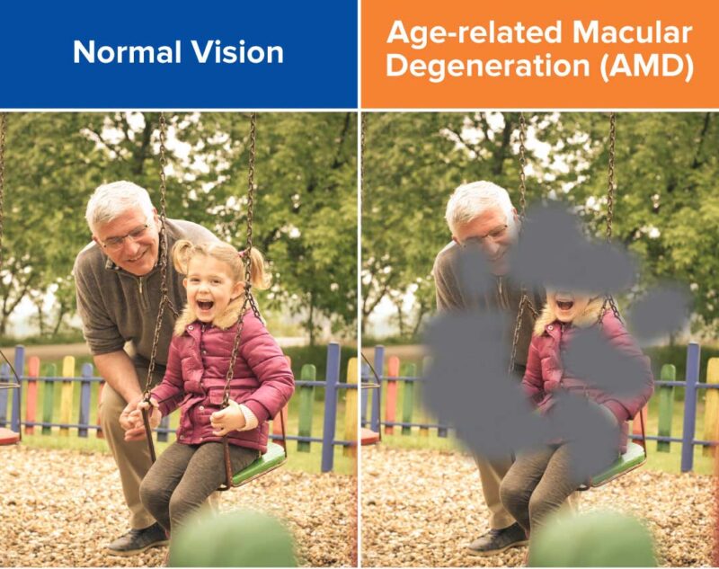 Syfovre: Dry Macular Degeneration Treatment in Venice FL